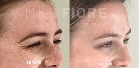 Anti Wrinkle Injections Hale Cheshire Med Fiore