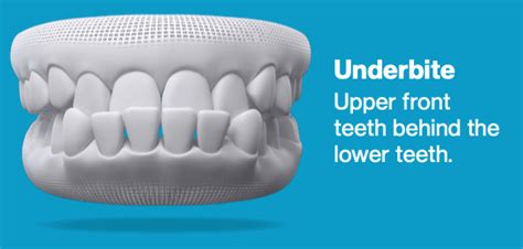 Can Invisalign Fix Underbite How To Get Faster Treatment