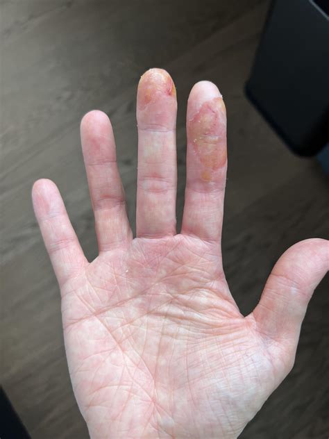 Also Known As Acute Vesiculobullous Hand Eczema 49 Off