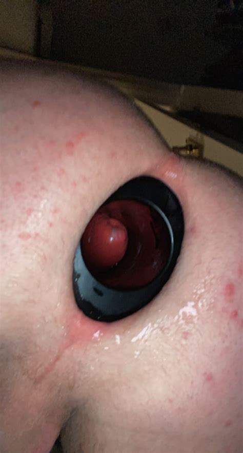 XXL MEO Anal Stretching Ring Pics XHamster