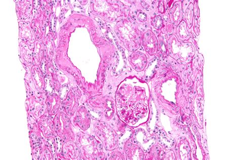 File:Renal amyloidosis - 2 - high mag.jpg - Libre Pathology