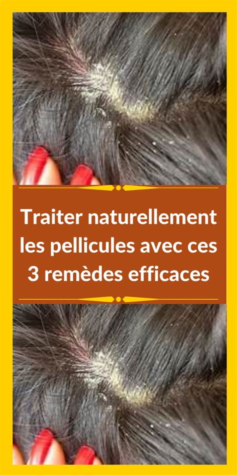 Traiter naturellement les pellicules avec ces 3 remèdes efficaces