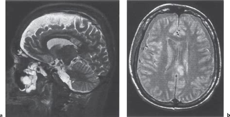 Craniocerebral Diseases Radiology Key