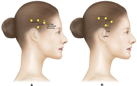 Figure 2 From A Proposal Of Injection Points Of Botulinum Toxin Into Temporal Region For Chronic