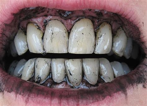 Tobacco Stains On Teeth The Cause And Available Solution