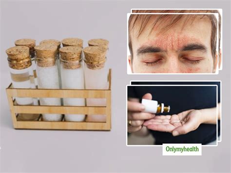 Seborrheic Dermatitis: 10 Homeopathic Remedies To Treat This Common Skin Disease | OnlyMyHealth