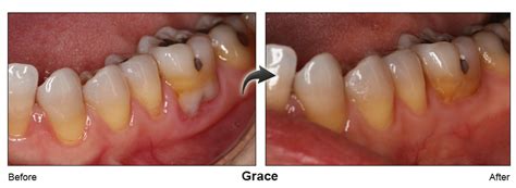 Amarillo Dentist Performs Chao Pinhole You Dont Have To Go Through