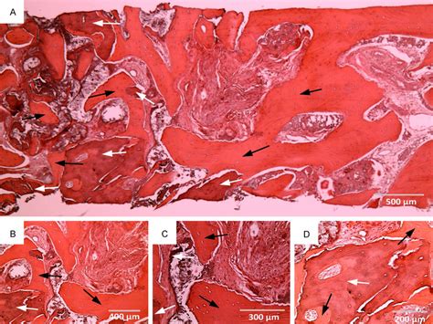 Photomicrograph Of The Biopsy Showing Trabecular Bone With Residual