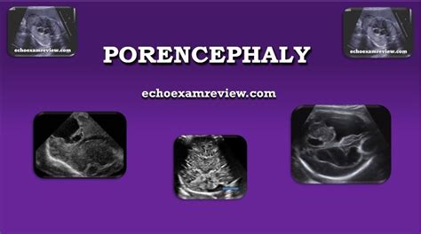 Porencephaly Ultrasound Cleft Lip And Palate Retroverted Uterus