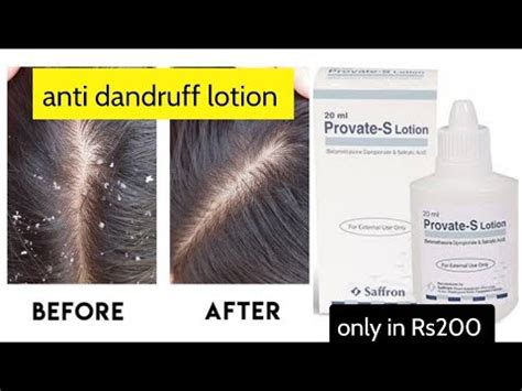 Provate S Lotion For Dandruff Best Anti Dandruff Lotion YouTube