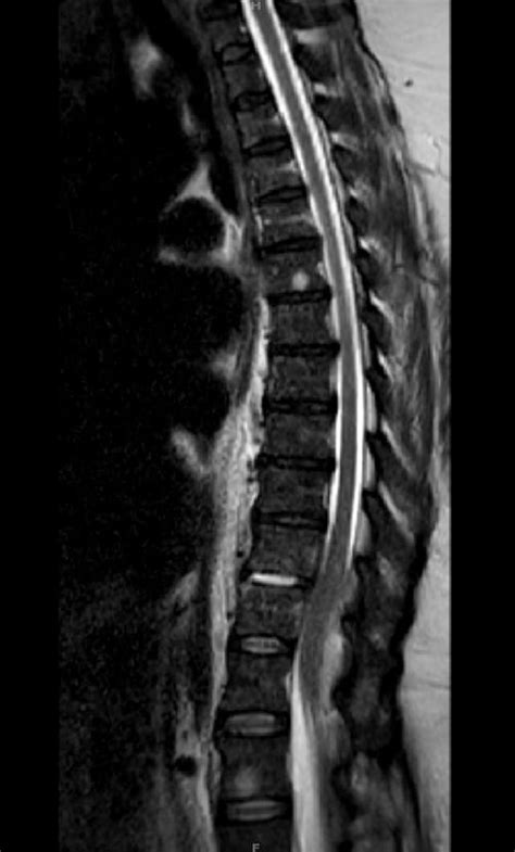 Sagittal View Of Contrast Enhanced Magnetic Resonance Imaging Of