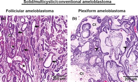 Peripheral Ameloblastoma Histology