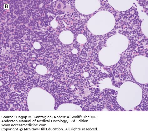 Indolent Lymphomas | Oncohema Key