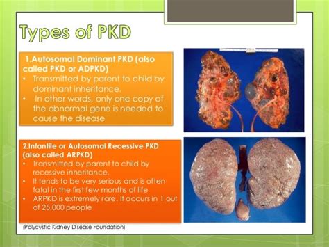 Polycystic kidney disease