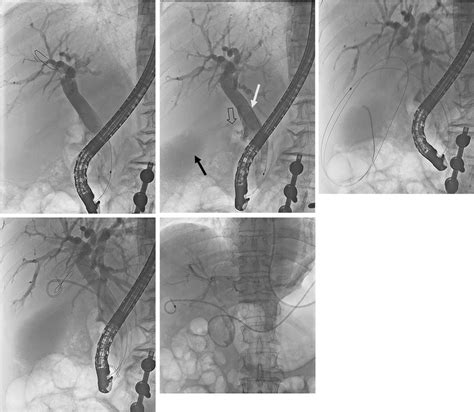 Endoscopic Transpapillary Gallbladder Drainage Via Endoscopic