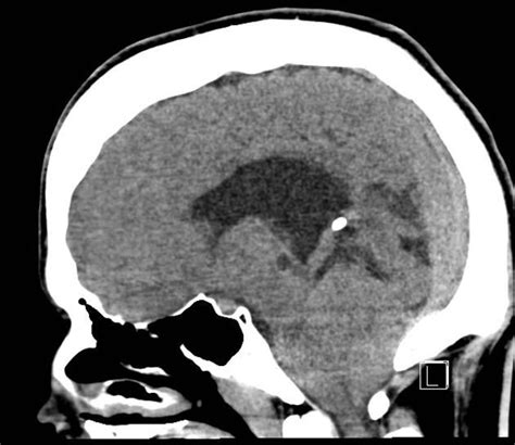 Arnold Chiari Malformation Radiology Case Chiari