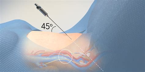 Abdominal Entry In Laparoscopic Gynecologic Surgery TVASurg The