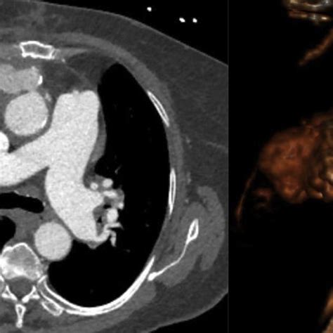 Preoperative Computed Tomography Angiogram Cta Left And Computed