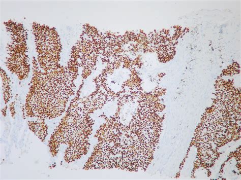 Basaloid Squamous Cell Carcinoma P40 Immunostain Case 275 … Flickr