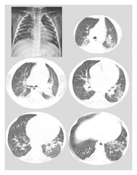 Chest X Ray And Ct Scan On The 3rd Day Of Admission Show Bilateral Download Scientific Diagram