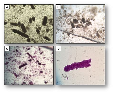 Urine Sediment Of The Month Granular Muddy Brown Casts Renal