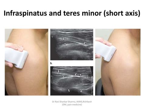 Diagnostic Ultrasound Of Shoulder Ppt