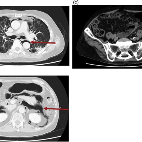 Pdf Mediastinal Retroperitoneal And Subcutaneous Emphysema Due To Sigmoid Colon Penetration