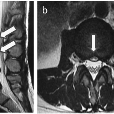 A Sagittal T2 Weighted Magnetic Resonance Image Showing A