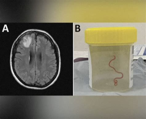 Australian Doctors Find Live Parasitic Worm In Woman S Brain Happiest