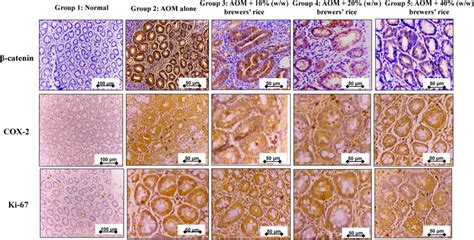 Immunohistochemical Staining Of β Catenin Cox 2 And Ki 67 The Download Scientific Diagram