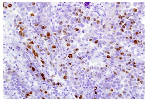 Evaluation Of The Possibility Of E Cadherin P Catenin And Cytokeratins