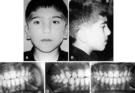 Design And Fabrication Of A Modified Protraction Headgear For Class Iii Long Face Patients