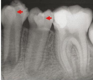 What is dens invaginatus or dens in dente? | News | Dentagama