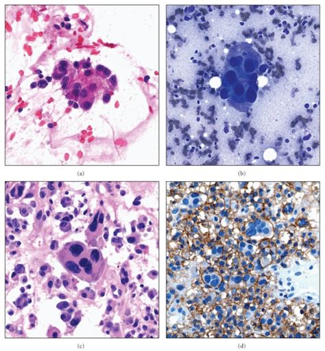 Anaplastic Plasmacytoma Of The Pelvic Bone Showing Atypical Plasma Download Scientific Diagram