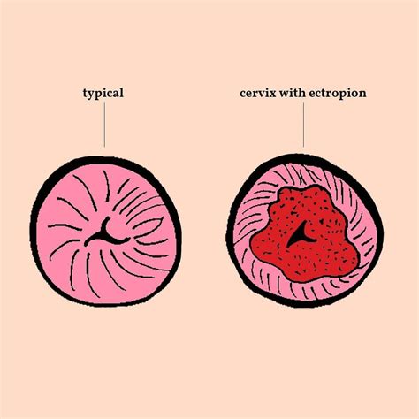 Female Anatomy: cervical ectropion | Body, Cervix, Female anatomy