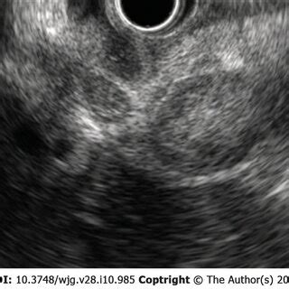 A 69 Year Old Woman Presented With Abdominal Pain And Jaundice 12 Mo