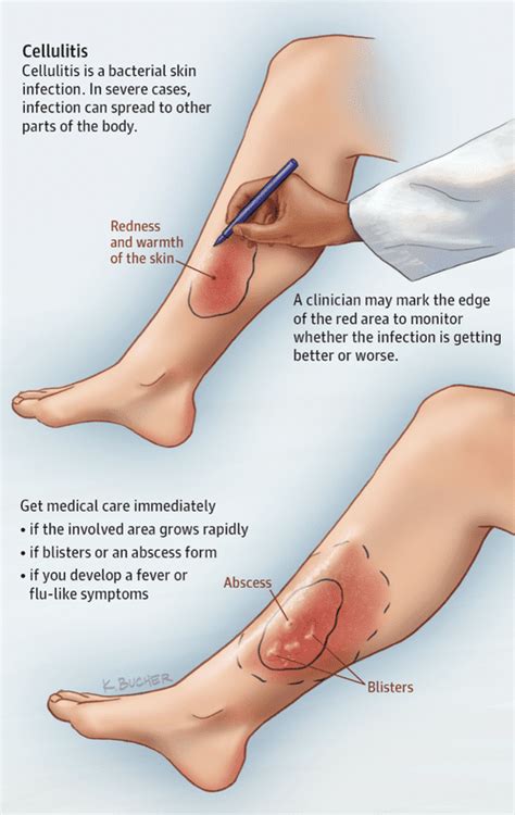 Things To Know About Cellulitis Manjulatha Badam MD CWSP UHM