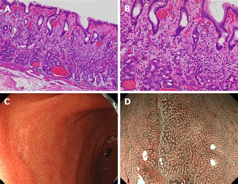 Pure Signet Ring Cell Carcinoma A B Pure Signet Ring Cell Carcinoma