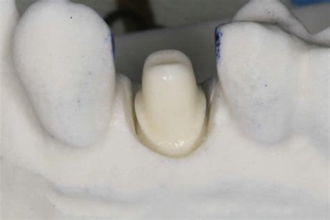 5 Axis Dental Design Center Scanning Jig For Itero Bone Level Implant