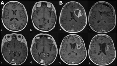 Frontiers Imaging Biomarkers Of Glioblastoma Treatment Response A