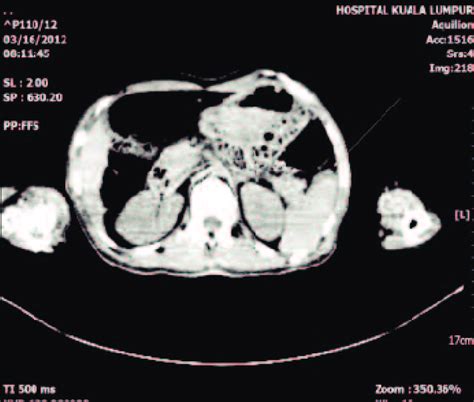 Axial View Of Plain Post Mortem Ct Scan Of A Patient Showing Hypodense Download Scientific