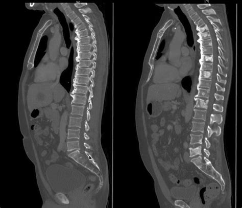 Sclerotic Changes Within Bone Metastases As Response To Treatment The