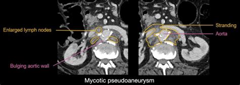 Abdominal Ct Aortic Aneurysm • Litfl • Radiology Library