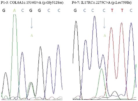 Sanger Sequencing Chromatograms Of Two Variants In Two Opll Associated