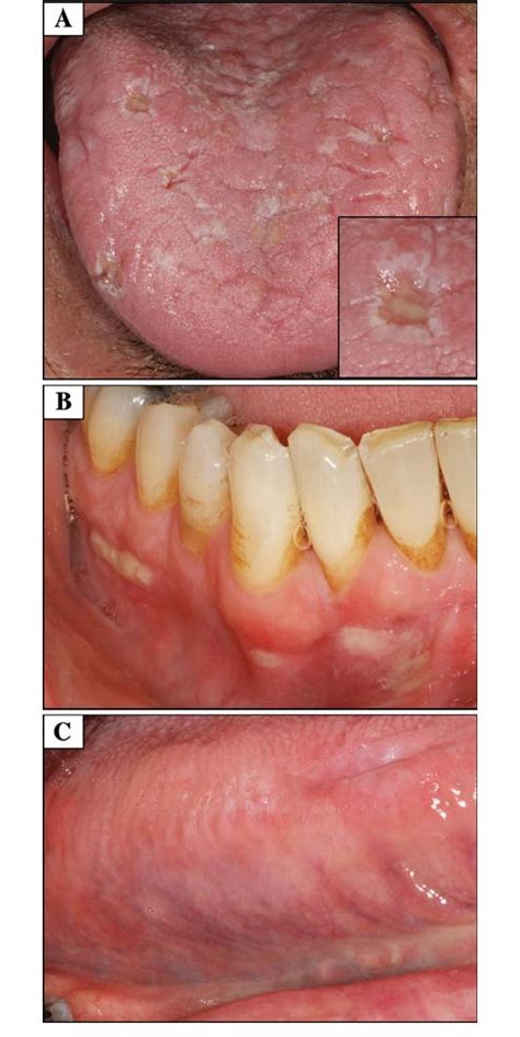 Initial Presentation The Dorsal Tongue Exhibits Fissures And Multiple