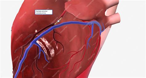 Premium Photo | Angina is chest pain or discomfort due to reduced blood ...