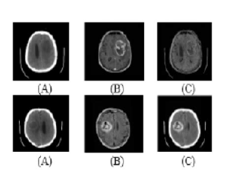 Medical Image Fusion Using Cnn With Automated Pooling