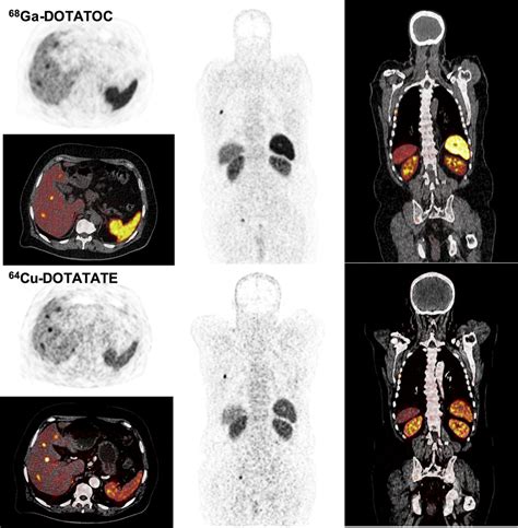 Head To Head Comparison Of 64Cu DOTATATE And 68Ga DOTATOC PET CT A