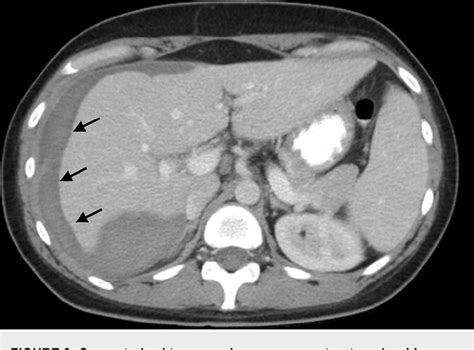 Figure 2 From Management Of Ruptured Subcapsular Liver Hematoma As A Result Of Hemolysis