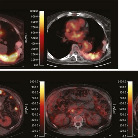 PET CT Fusion Images Of Tumor Uptake Of Two Patients The Upper Row